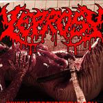 Leprosy
